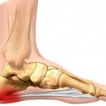 plantar-fascia_13